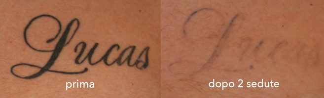 Rimozione tatuaggio prima e dopo 2 sedute - Foto - 2